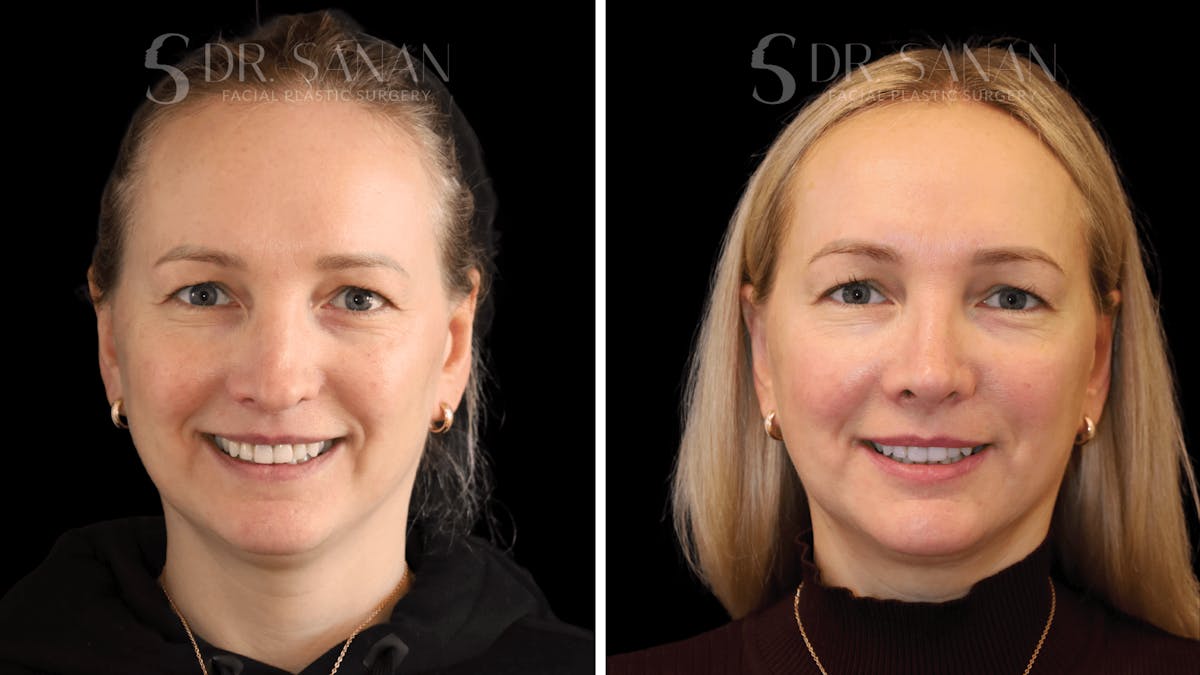 Rhinoplasty Before & After Gallery - Patient 175477 - Image 5