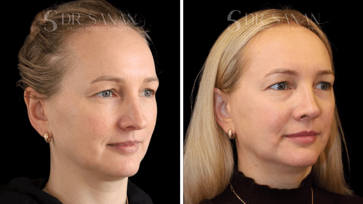 Rhinoplasty Before & After Gallery - Patient 175477 - Image 3