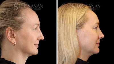 Rhinoplasty Before & After Gallery - Patient 175477 - Image 1