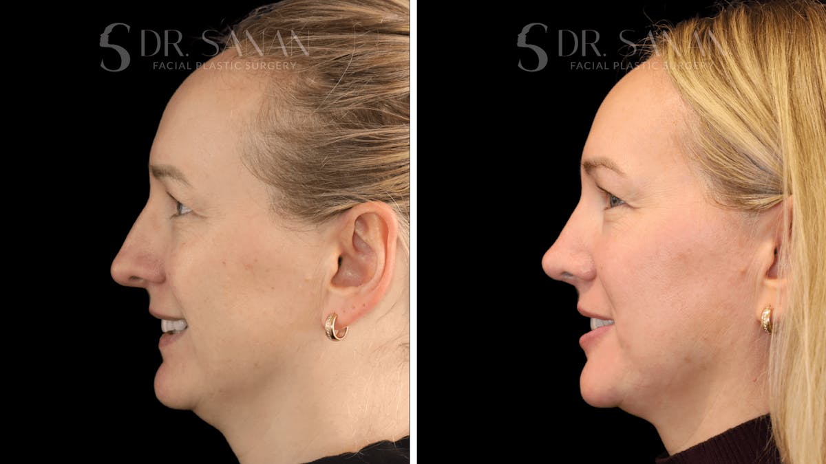 Rhinoplasty Before & After Gallery - Patient 175477 - Image 7