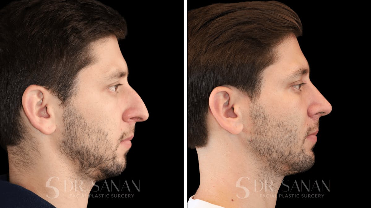Rhinoplasty Before & After Gallery - Patient 266737 - Image 1