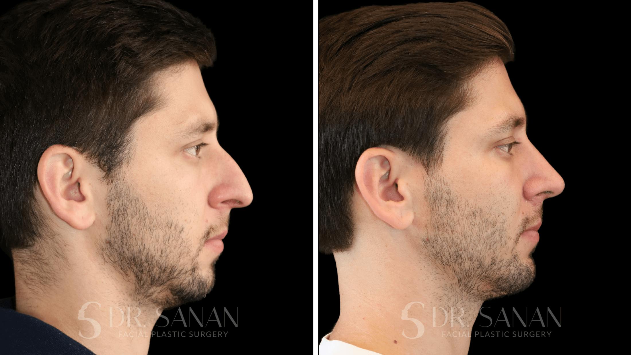Rhinoplasty Before & After Gallery - Patient 266737 - Image 1
