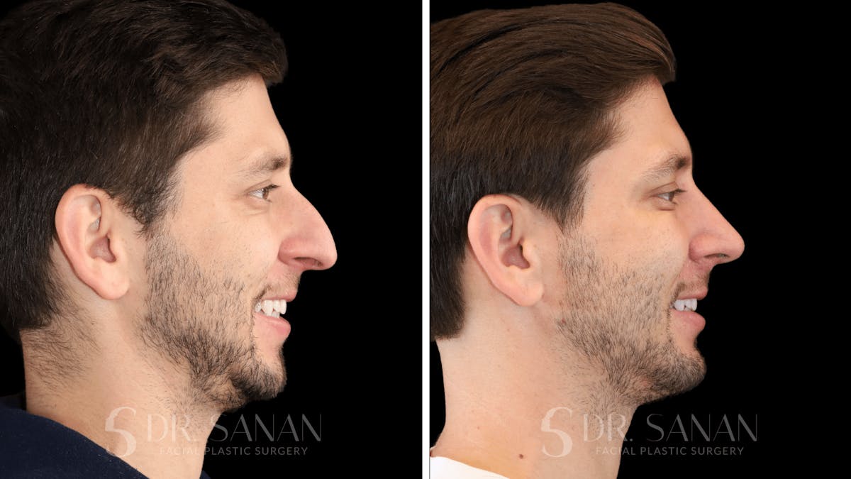 Rhinoplasty Before & After Gallery - Patient 266737 - Image 6