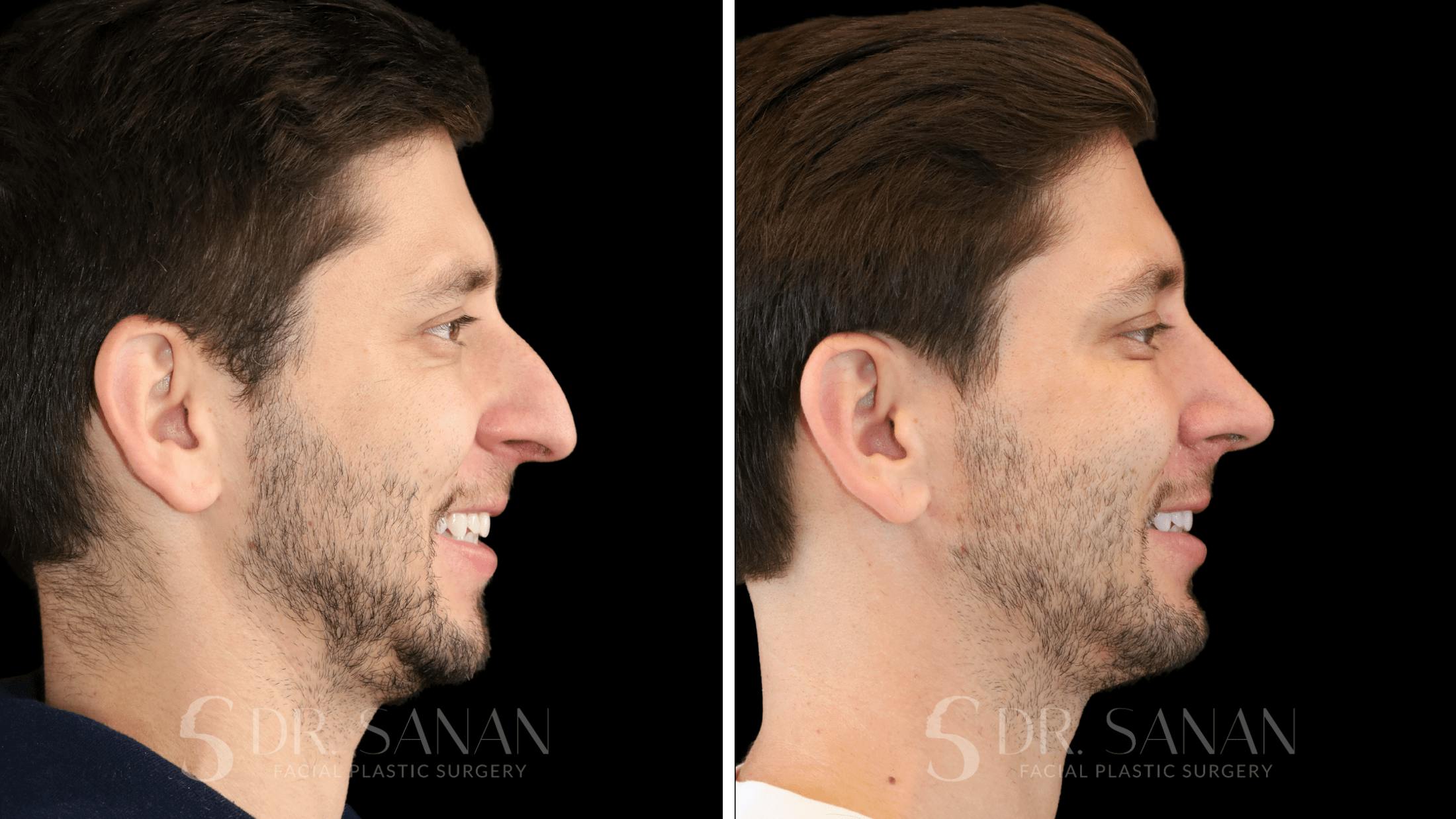 Rhinoplasty Before & After Gallery - Patient 266737 - Image 6