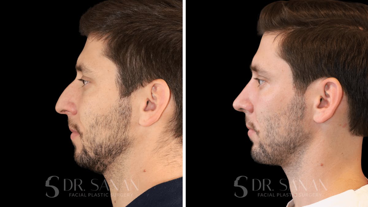 Rhinoplasty Before & After Gallery - Patient 266737 - Image 2