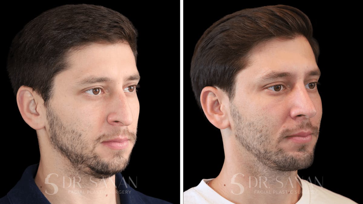 Rhinoplasty Before & After Gallery - Patient 266737 - Image 4