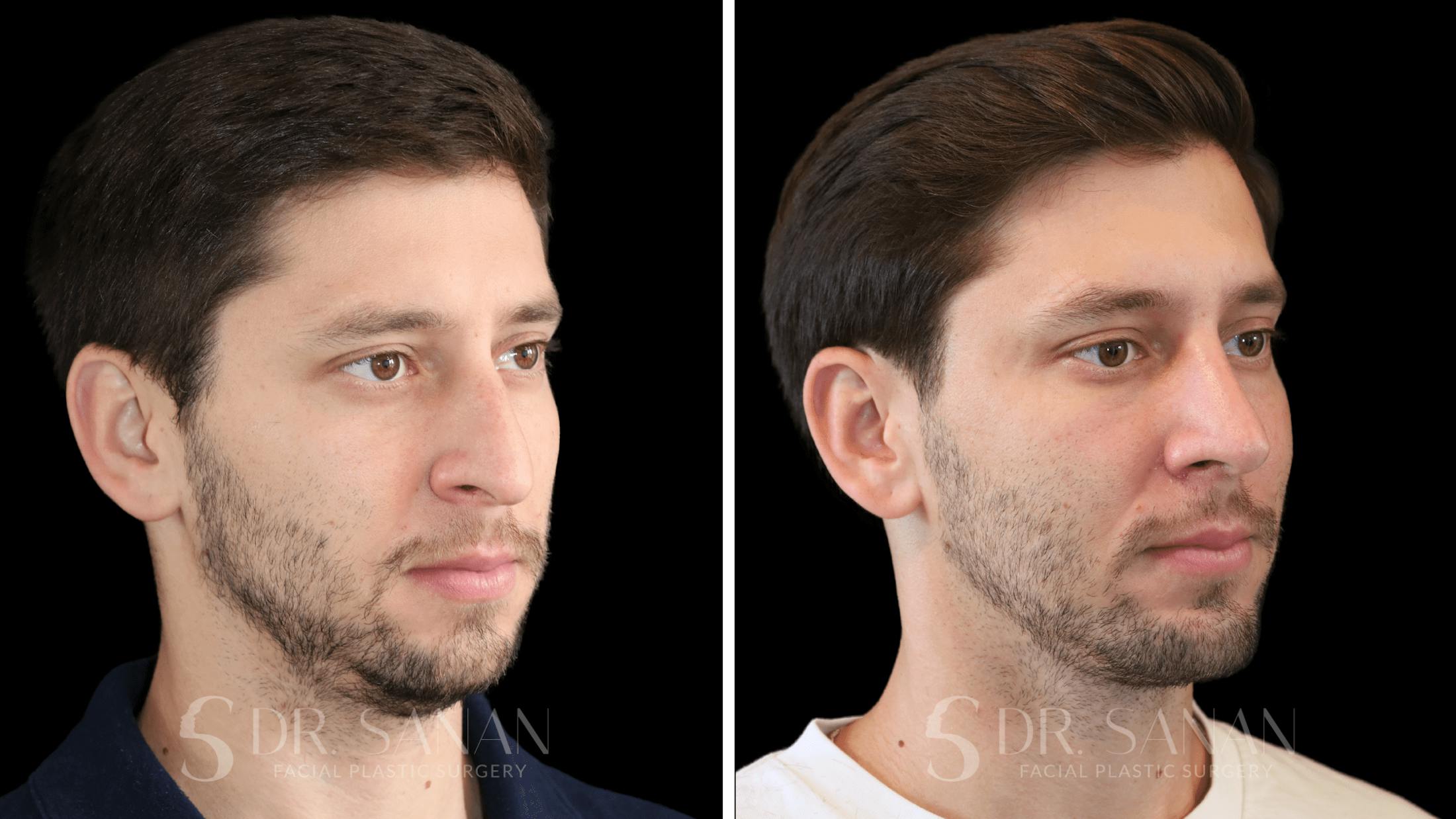 Rhinoplasty Before & After Gallery - Patient 266737 - Image 4