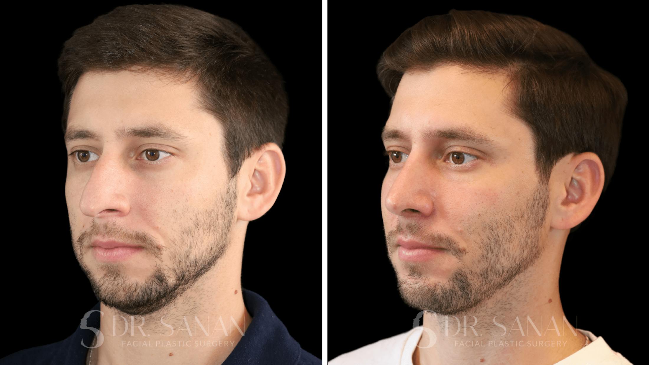 Rhinoplasty Before & After Gallery - Patient 266737 - Image 5