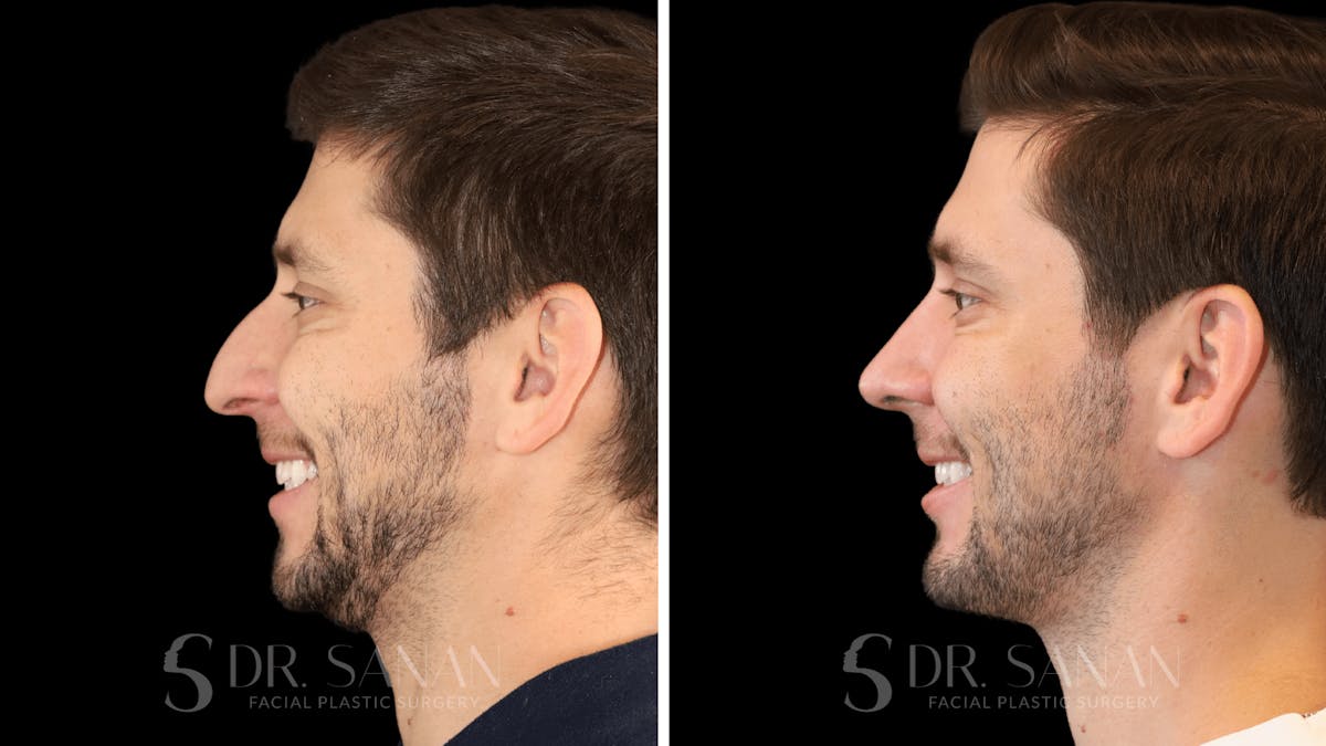 Rhinoplasty Before & After Gallery - Patient 266737 - Image 7