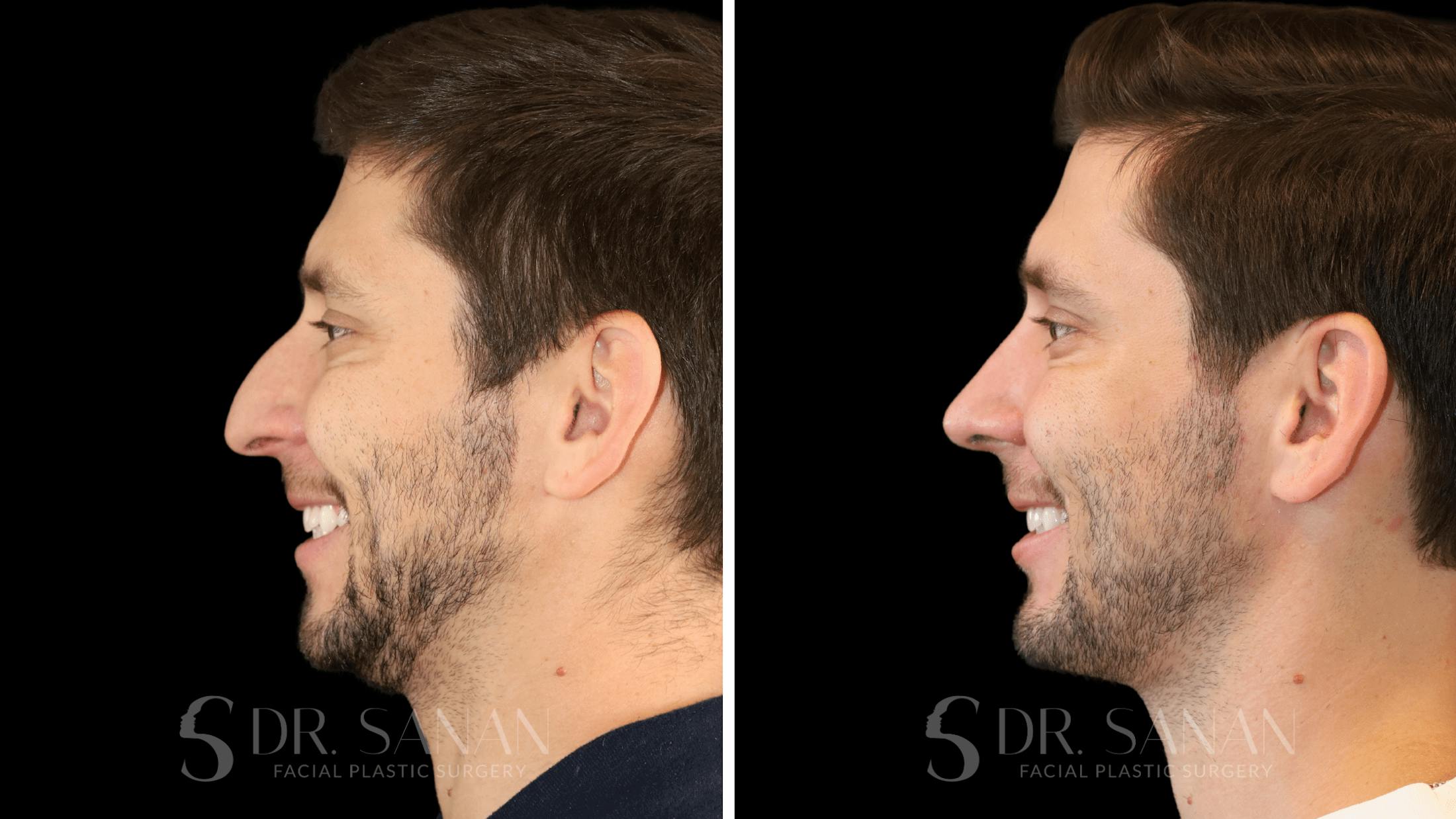 Rhinoplasty Before & After Gallery - Patient 266737 - Image 7