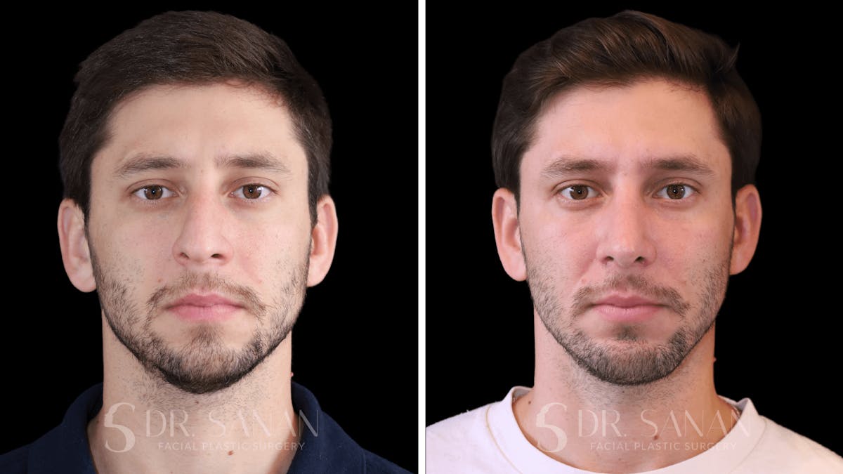 Rhinoplasty Before & After Gallery - Patient 266737 - Image 3