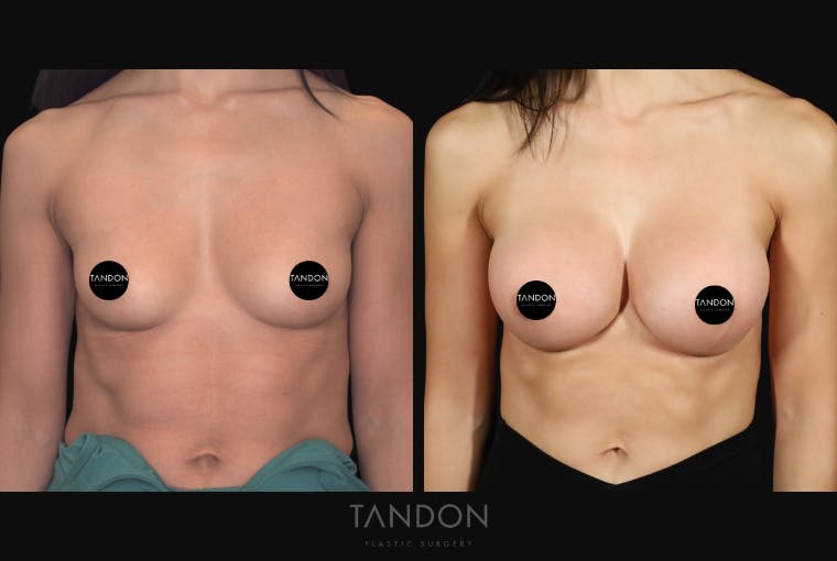 Breast Augmentation Before & After Gallery - Patient 630441 - Image 1