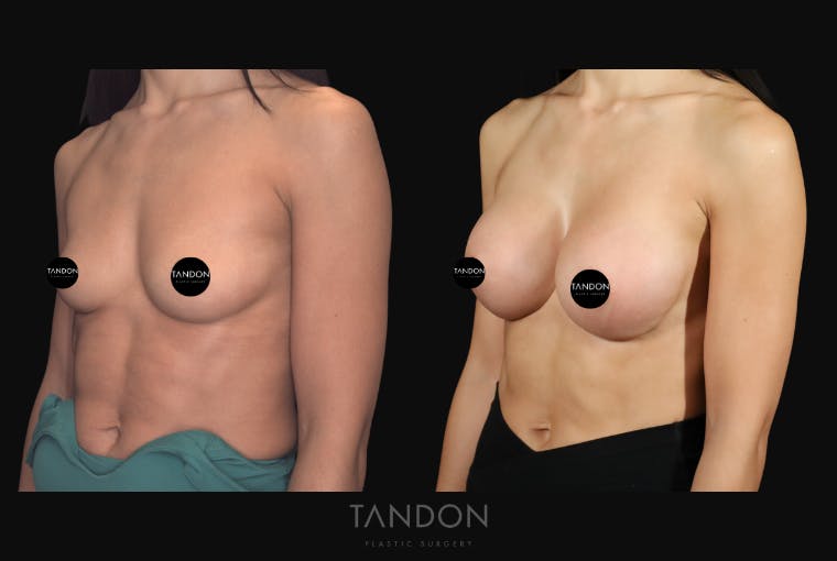 Breast Augmentation Before & After Gallery - Patient 630441 - Image 3