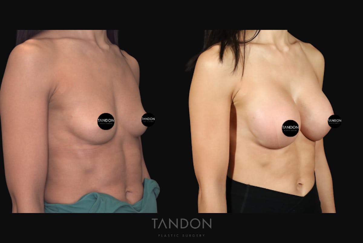 Breast Augmentation  Before & After Gallery - Patient 630441 - Image 2