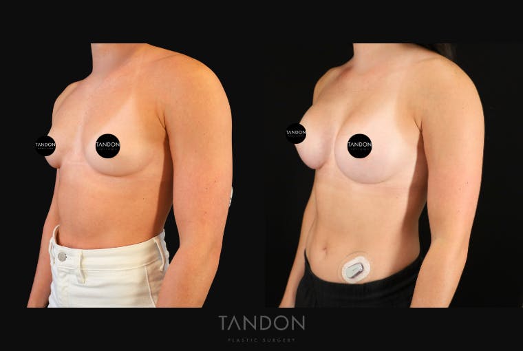 Breast Augmentation Before & After Gallery - Patient 360246 - Image 4
