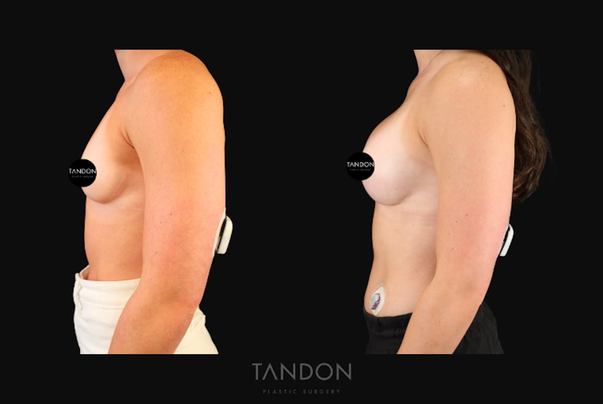 Breast Augmentation Before & After Gallery - Patient 119036 - Image 4