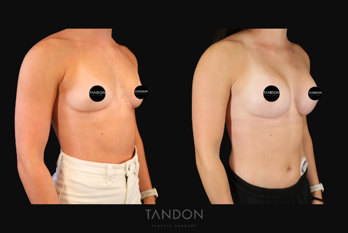 Breast Augmentation  Before & After Gallery - Patient 360246 - Image 3