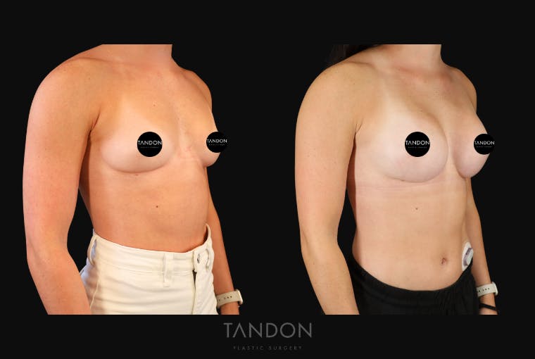 Breast Augmentation Before & After Gallery - Patient 360246 - Image 3