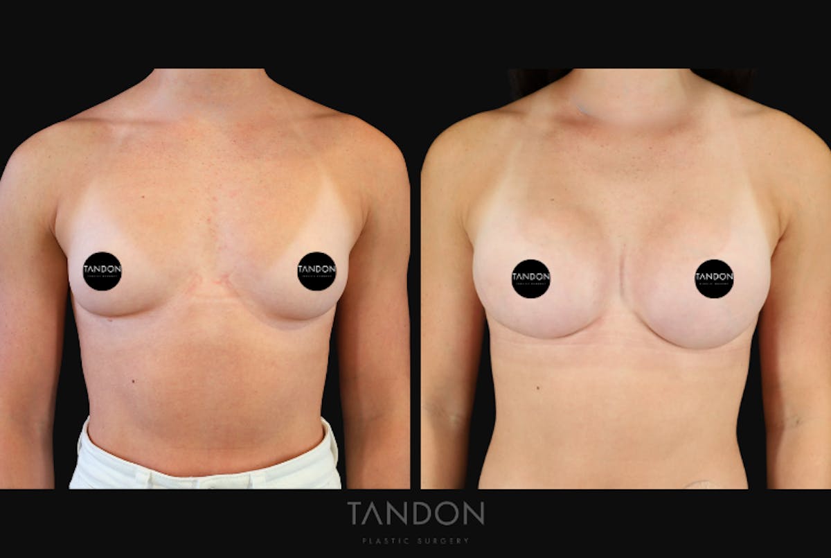Breast Augmentation  Before & After Gallery - Patient 360246 - Image 1