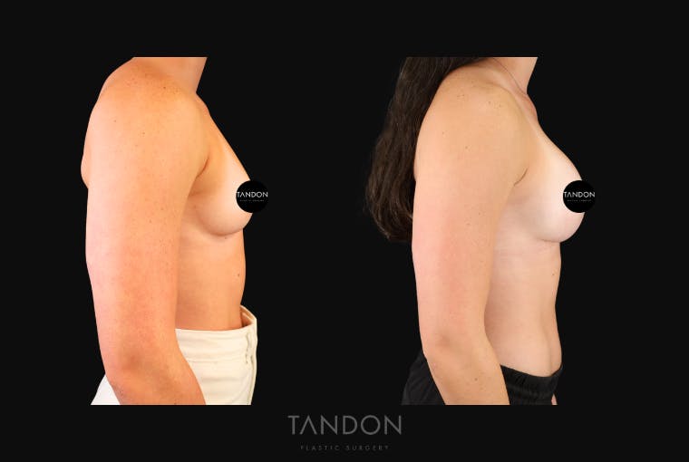 Breast Augmentation Before & After Gallery - Patient 360246 - Image 2