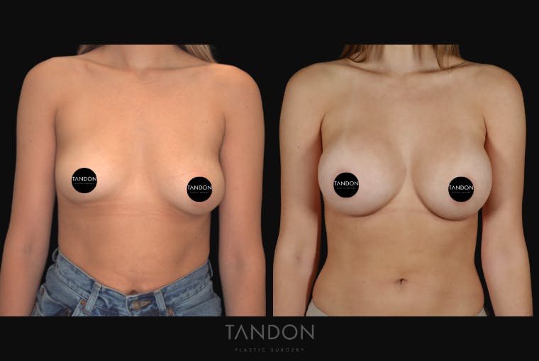 Breast Augmentation Before & After Gallery - Patient 213842 - Image 1