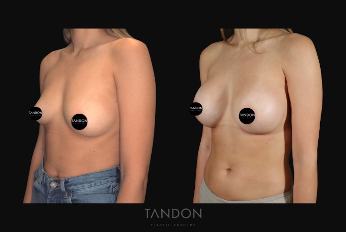 Breast Augmentation  Before & After Gallery - Patient 213842 - Image 2
