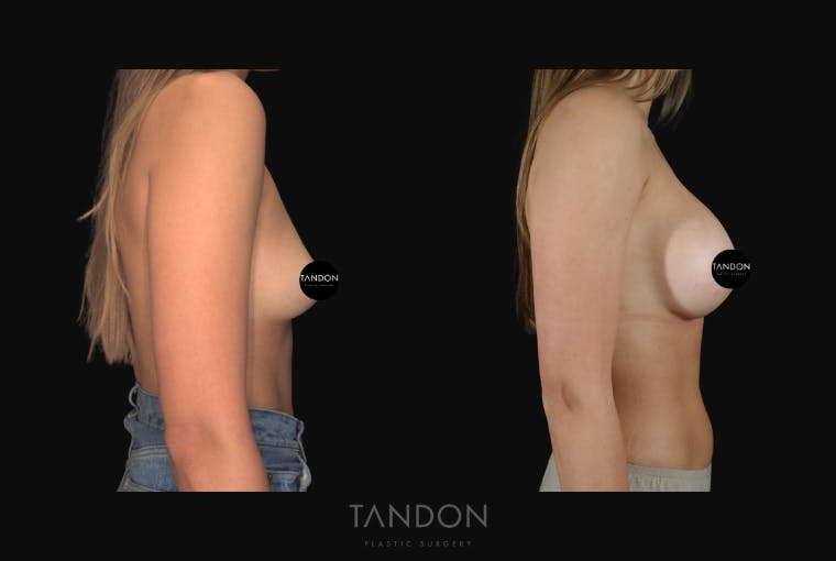 Breast Augmentation Before & After Gallery - Patient 213842 - Image 4