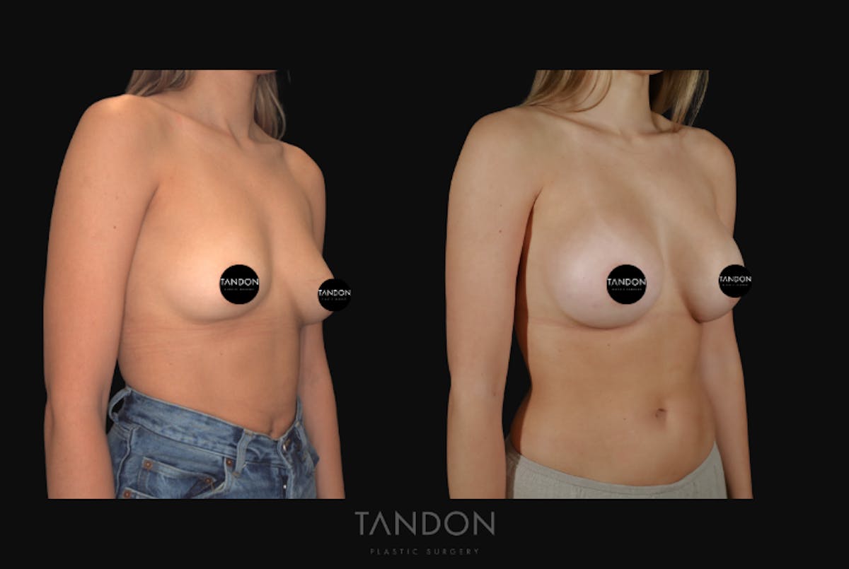 Breast Augmentation  Before & After Gallery - Patient 213842 - Image 3