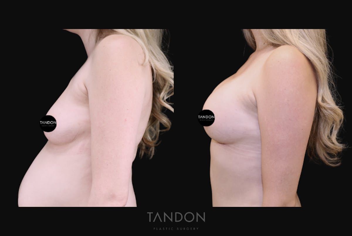Breast Augmentation  Before & After Gallery - Patient 415601 - Image 3
