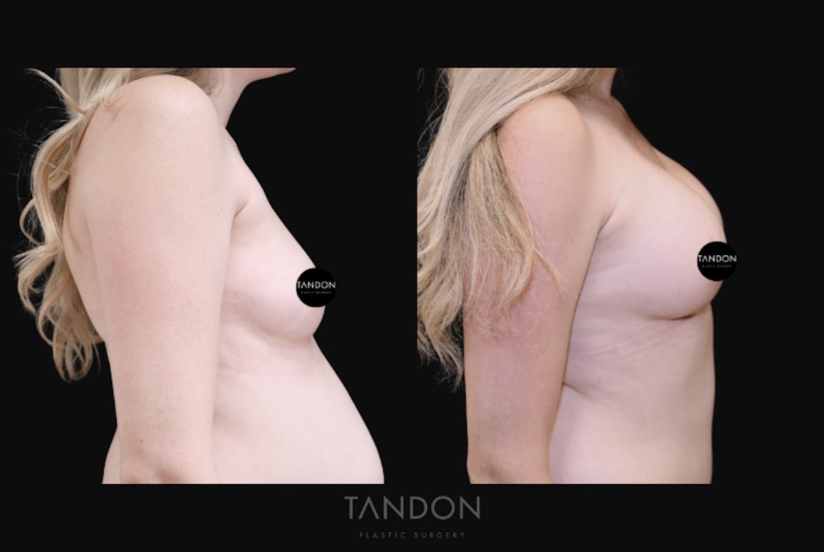 Breast Augmentation  Before & After Gallery - Patient 415601 - Image 2