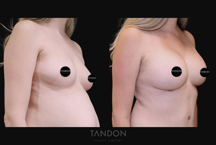 Breast Augmentation Before & After Gallery - Patient 415601 - Image 5
