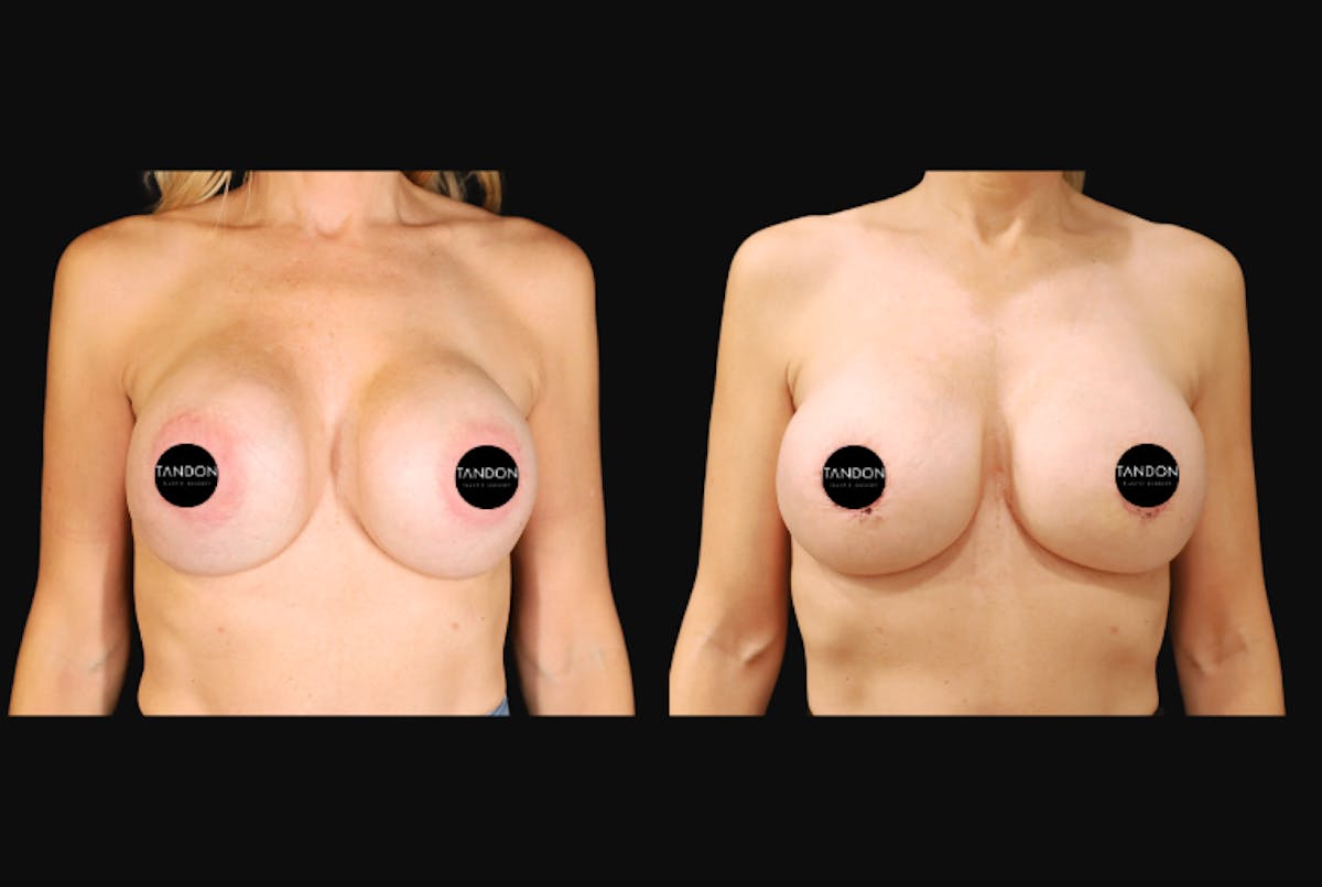Breast Revision Before & After Gallery - Patient 358161 - Image 1