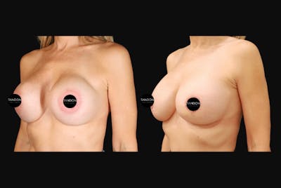 Breast Augmentation Before & After Gallery - Patient 220627 - Image 1