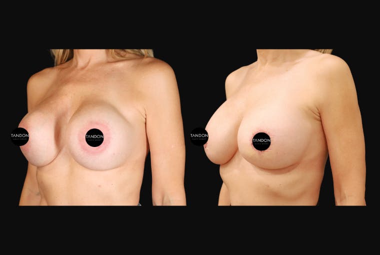 Breast Revision Before & After Gallery - Patient 358161 - Image 2