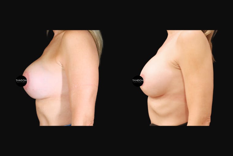 Breast Revision Before & After Gallery - Patient 358161 - Image 3