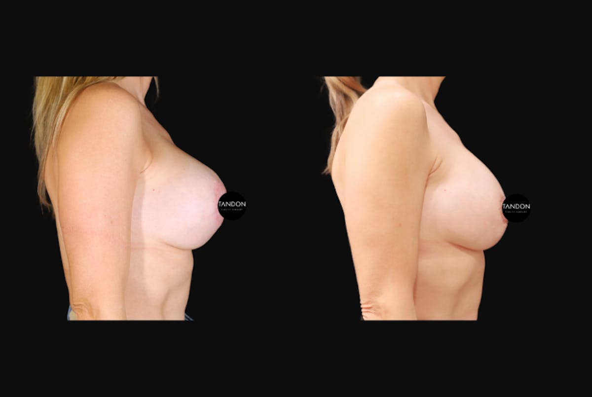 Breast Revision Before & After Gallery - Patient 358161 - Image 4