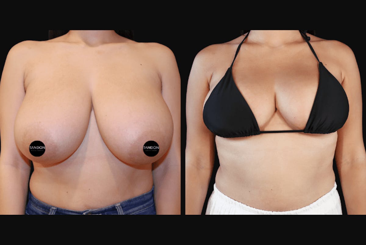 Breast Reduction Before & After Gallery - Patient 223759 - Image 2