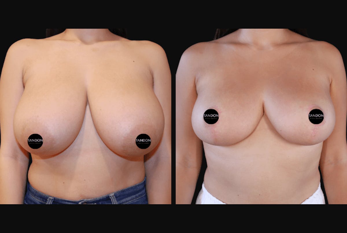 Breast Reduction Before & After Gallery - Patient 223759 - Image 1