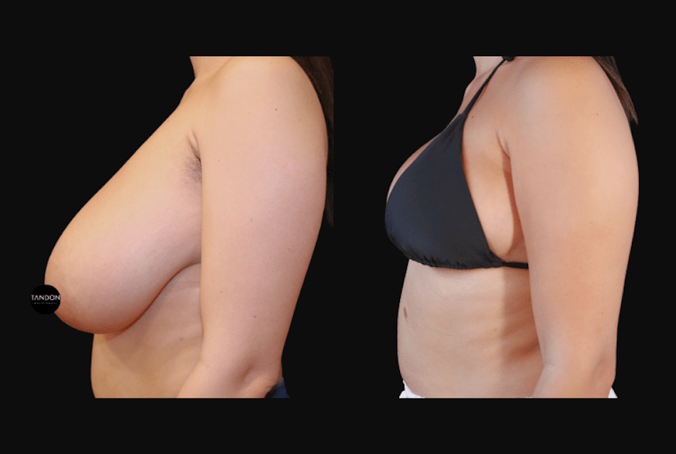 Breast Reduction Before & After Gallery - Patient 223759 - Image 6