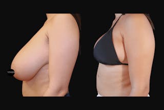 Breast Reduction Before & After Gallery - Patient 223759 - Image 6