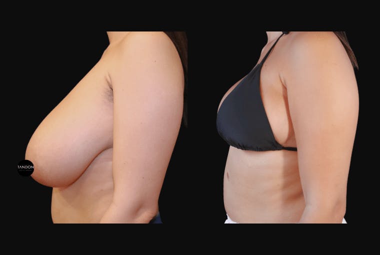 Breast Reduction Before & After Gallery - Patient 223759 - Image 6