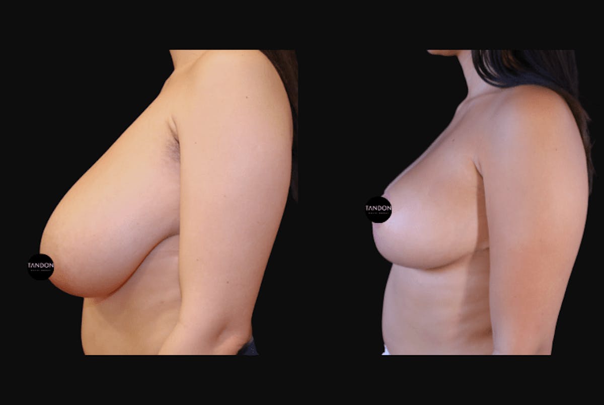 Breast Reduction Before & After Gallery - Patient 223759 - Image 5