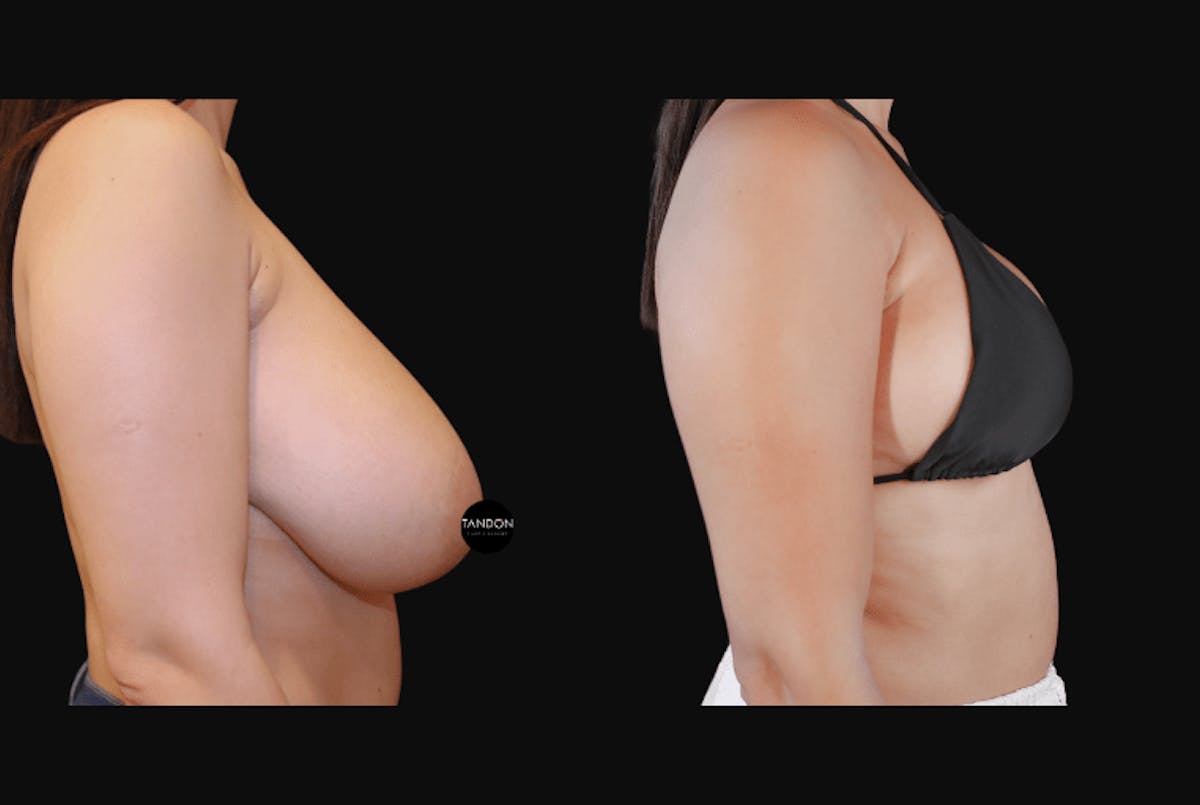 Breast Reduction Before & After Gallery - Patient 223759 - Image 4
