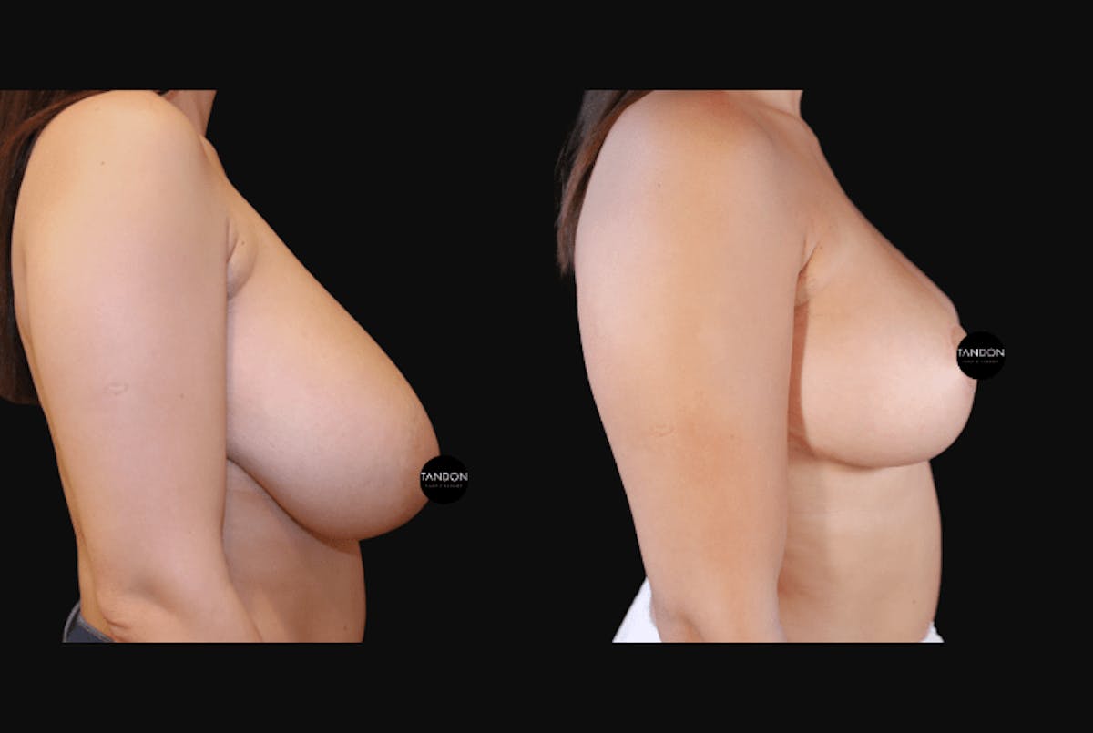 Breast Reduction Before & After Gallery - Patient 223759 - Image 3