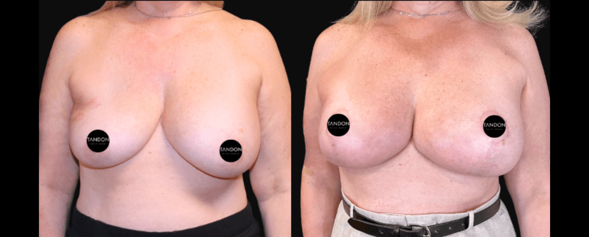 Breast Implant Exchange Before & After Gallery - Patient 335837 - Image 1