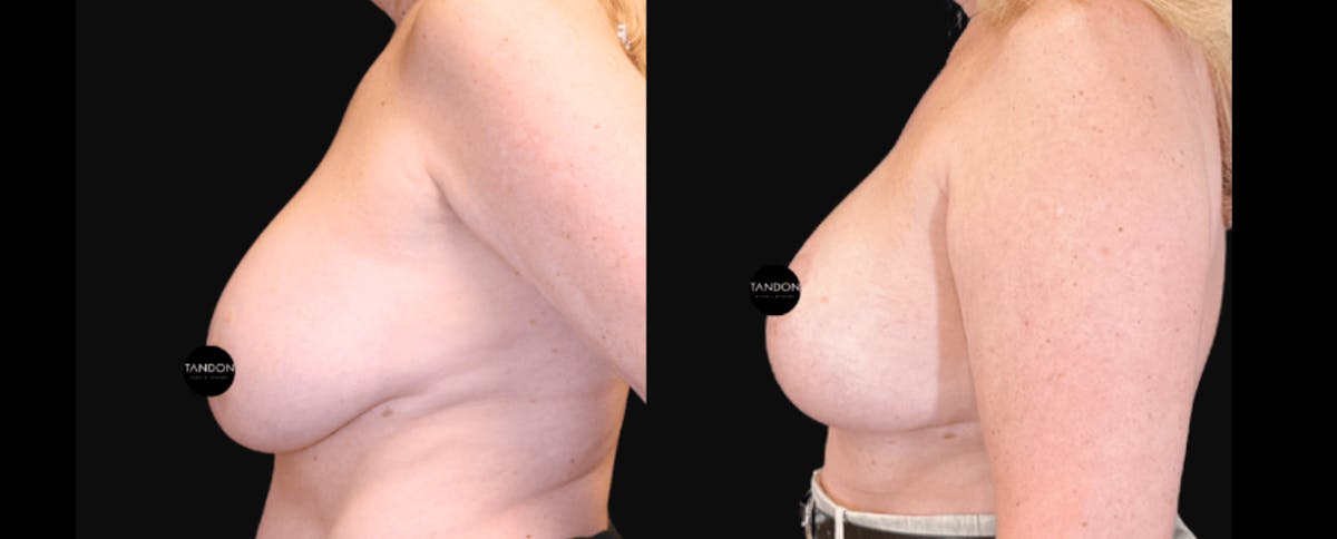 Breast Implant Exchange Before & After Gallery - Patient 335837 - Image 3