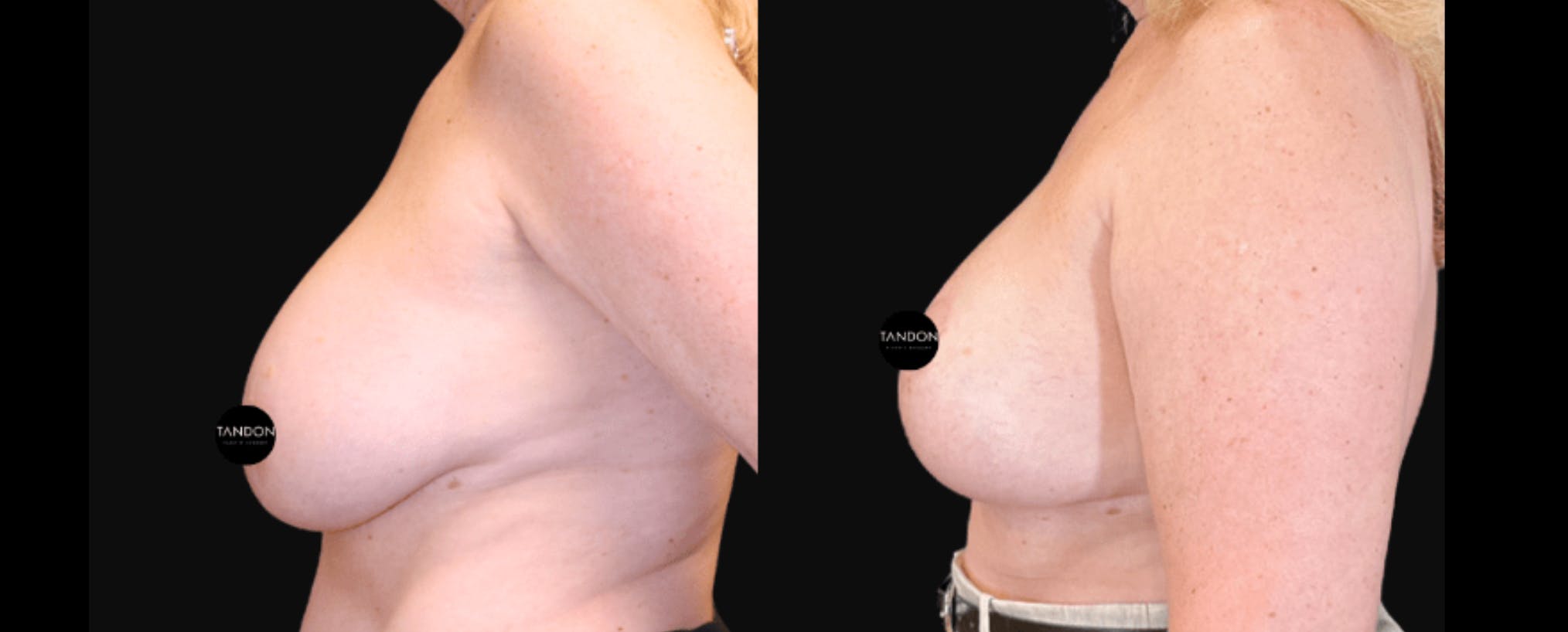 Breast Implant Exchange Before & After Gallery - Patient 335837 - Image 3