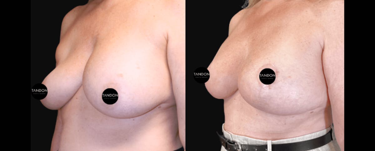 Breast Implant Exchange Before & After Gallery - Patient 335837 - Image 2