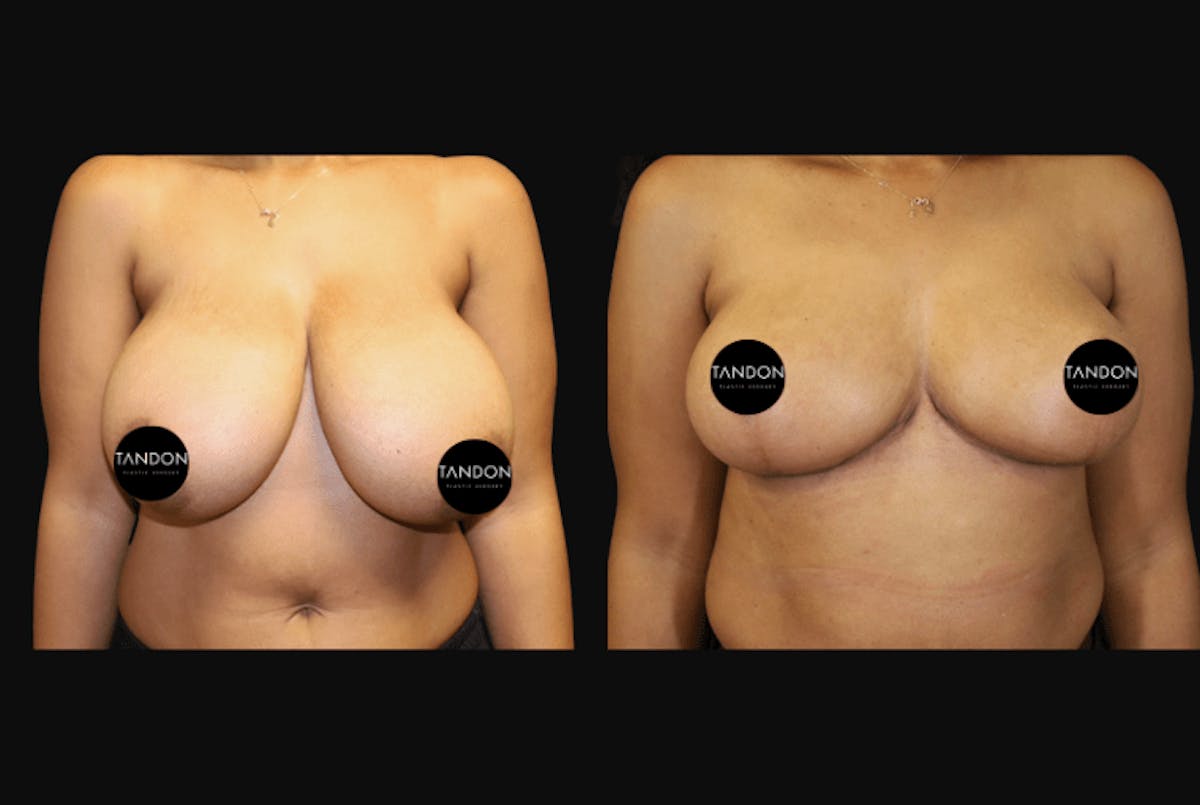 Breast Reduction Before & After Gallery - Patient 103021 - Image 1