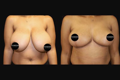 Breast Reduction Before & After Gallery - Patient 103021 - Image 1